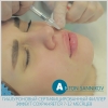 Увеличение и изменение формы губ гиалуроновыми филлерами (реклама салона красоты)